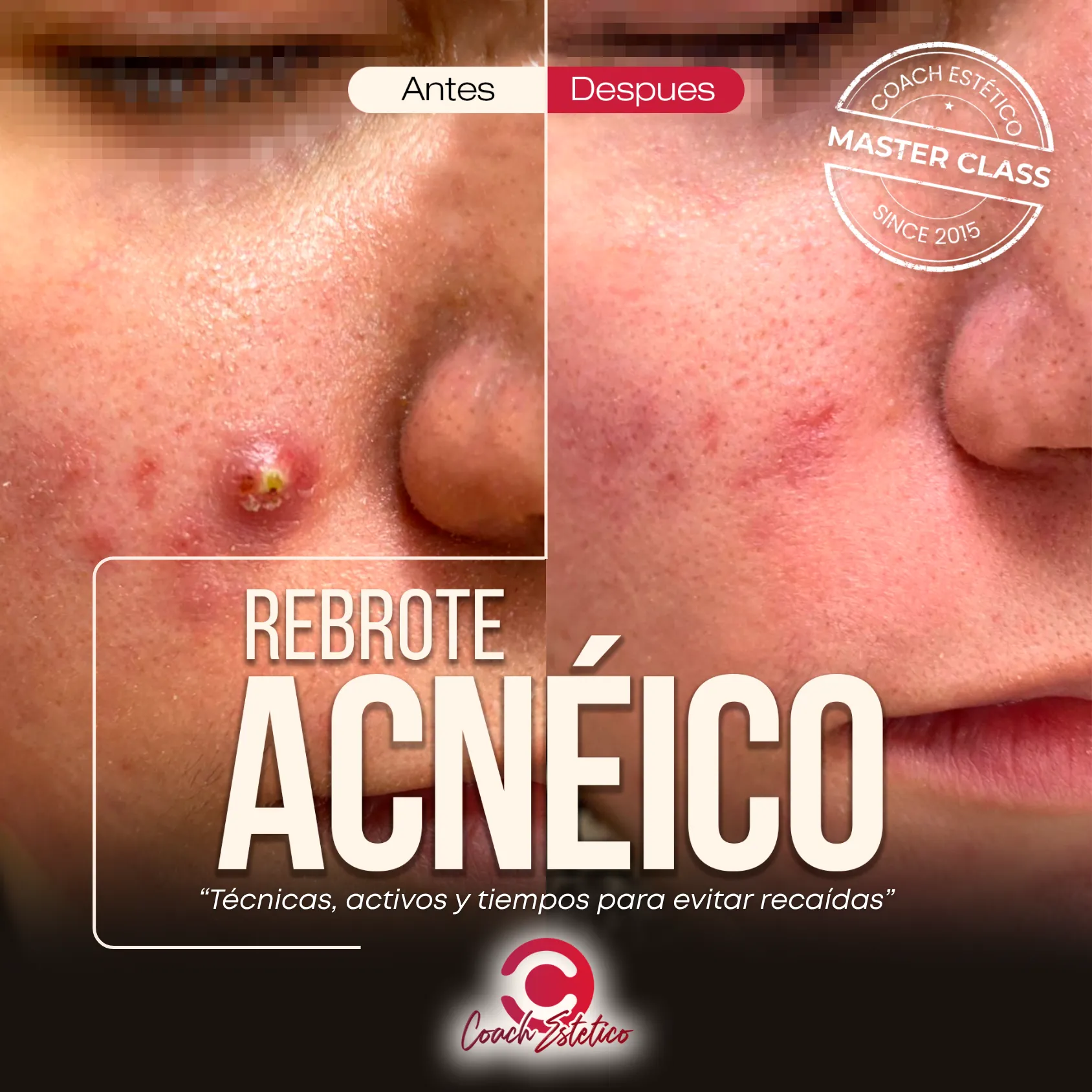 Rebrote Acnéico