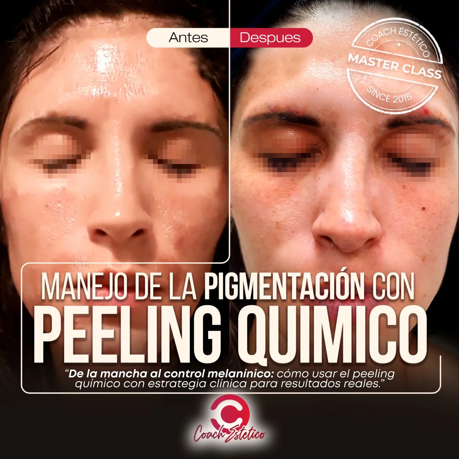 Manejo de la Pigmentación con Peeling Químico