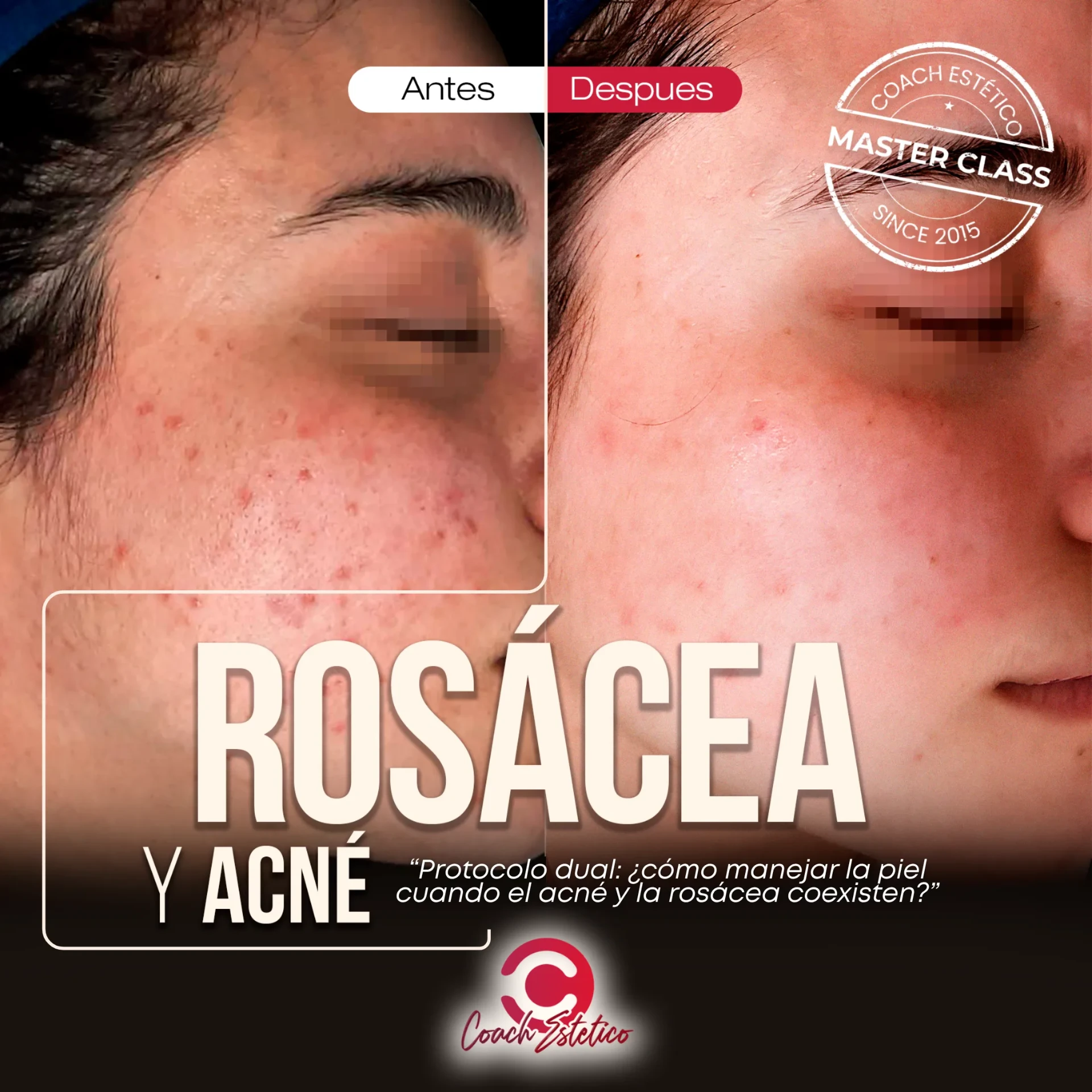 Rosácea y Acné