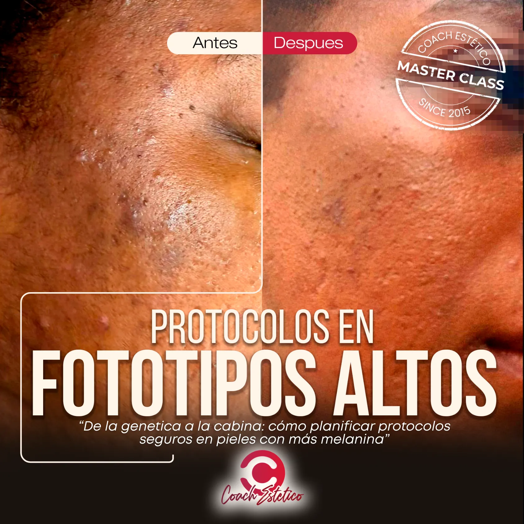 Protocolos en Fototipos Altos