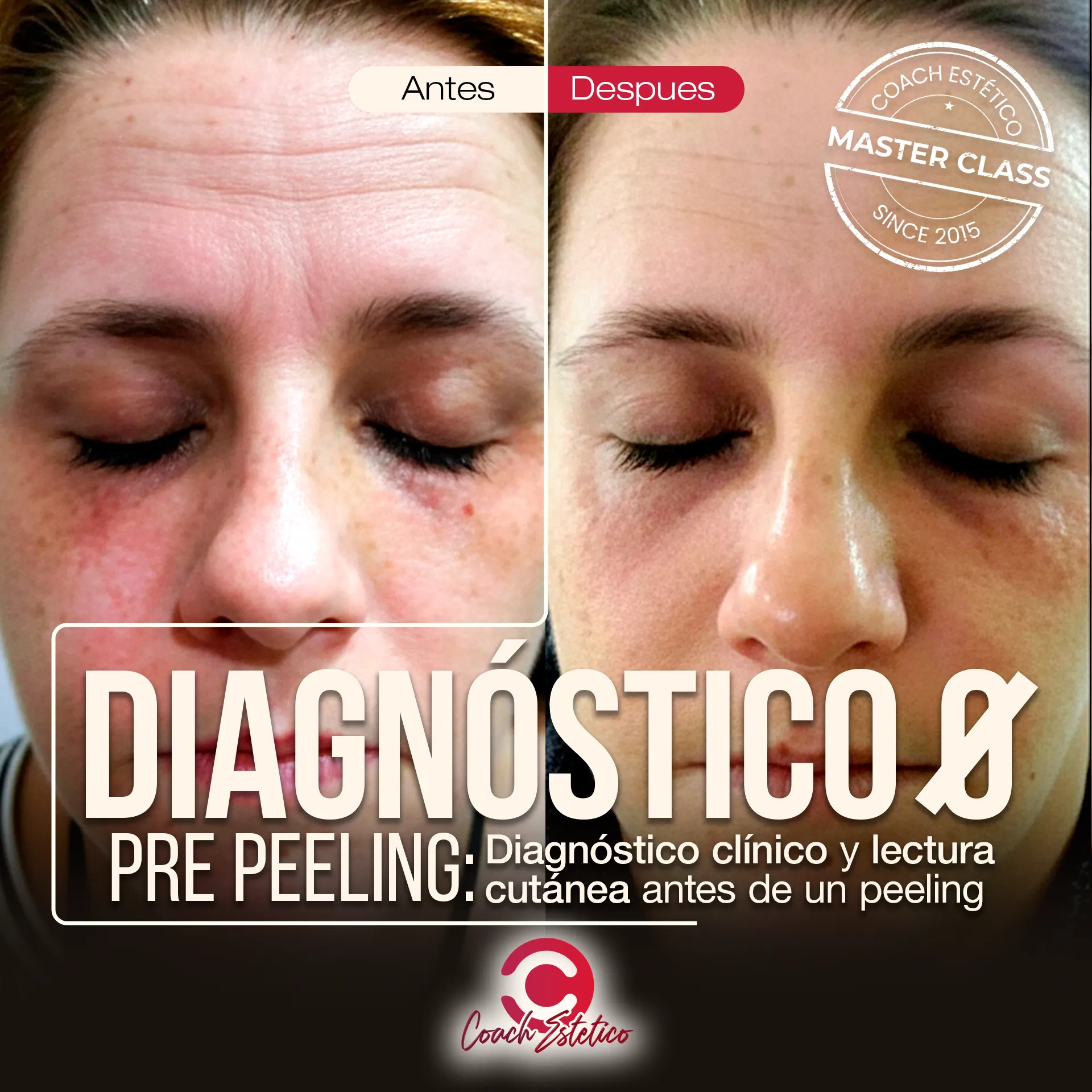 Diagnóstico Ø Pre Peeling