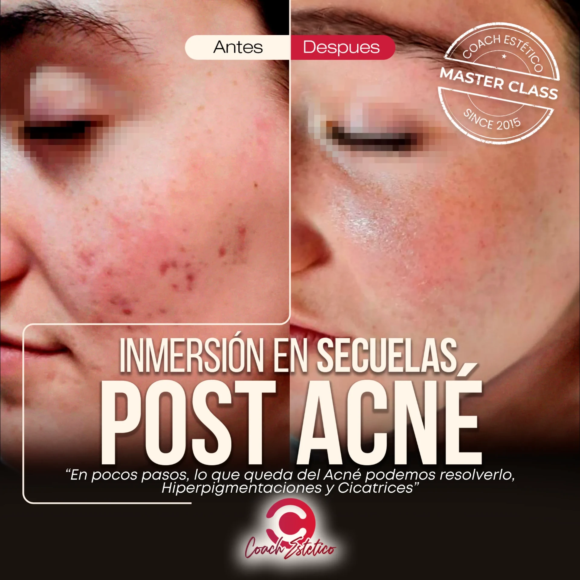 Inmersión en Secuelas Post Acné